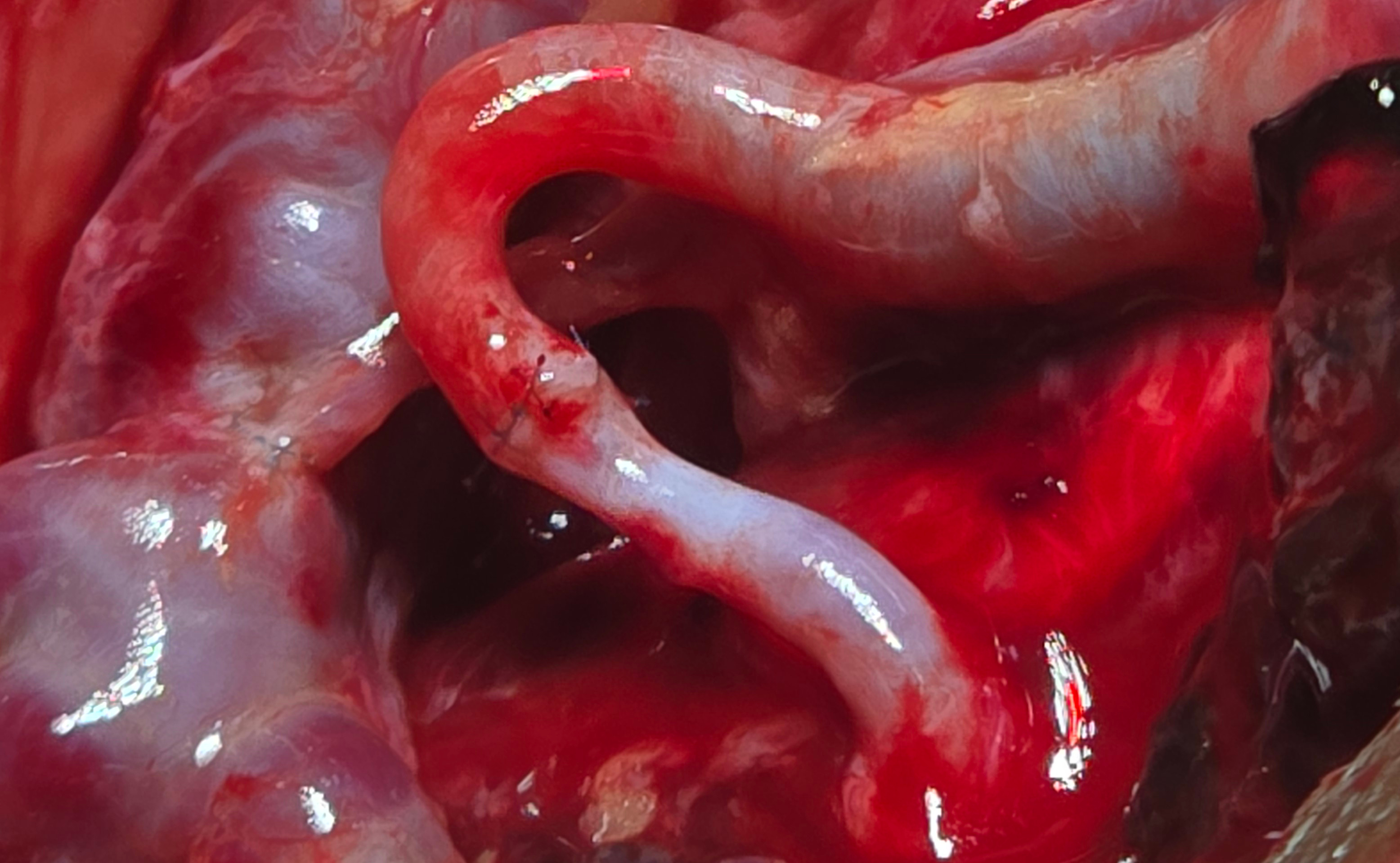 Pre-operative view of Mr. Sunil showing the buccal lesion on the right inner cheek