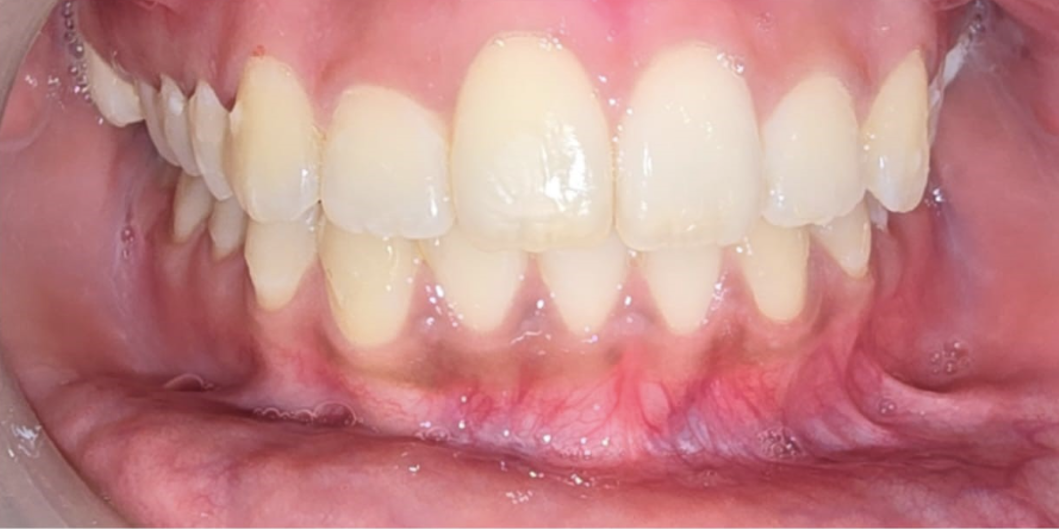 Post-treatment view showing aligned upper front teeth after approximately five months of directly 3D-printed Clear Plus Shape Memory Aligner therapy