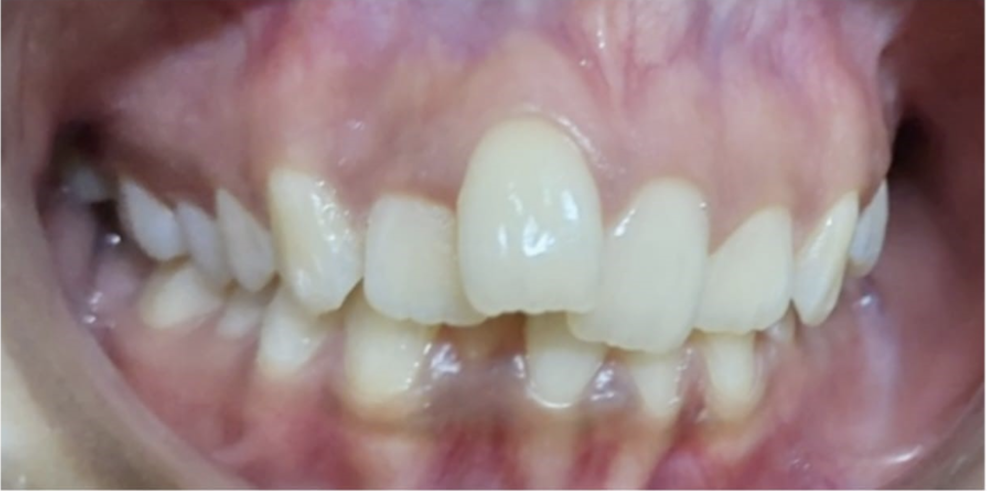 Pre-treatment view showing crowded and overlapping upper front teeth