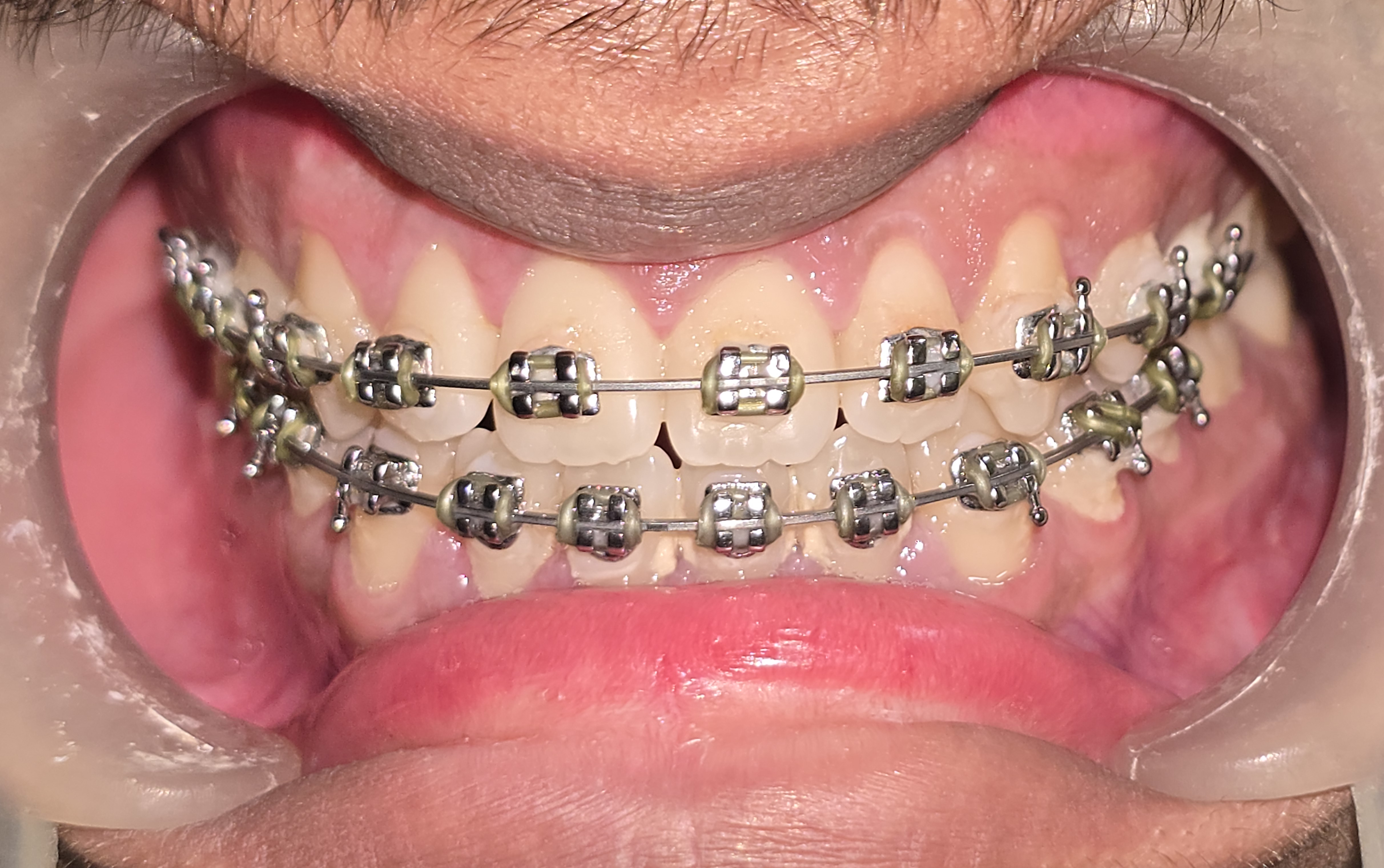 Post-operative intraoral view showing corrected bite with post-surgical orthodontic refinement