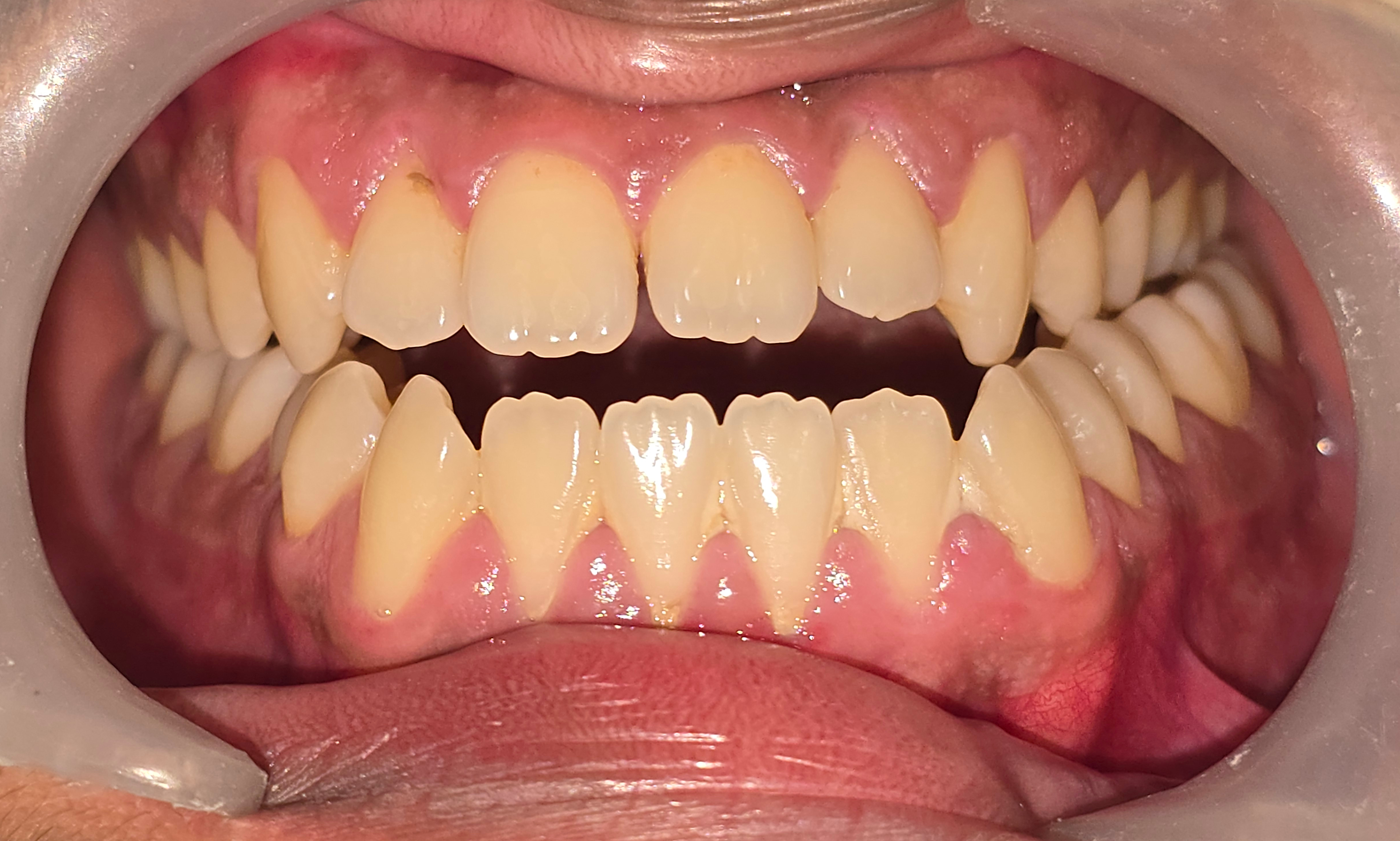 Pre-operative intraoral view showing skeletal Class III underbite with anterior open bite