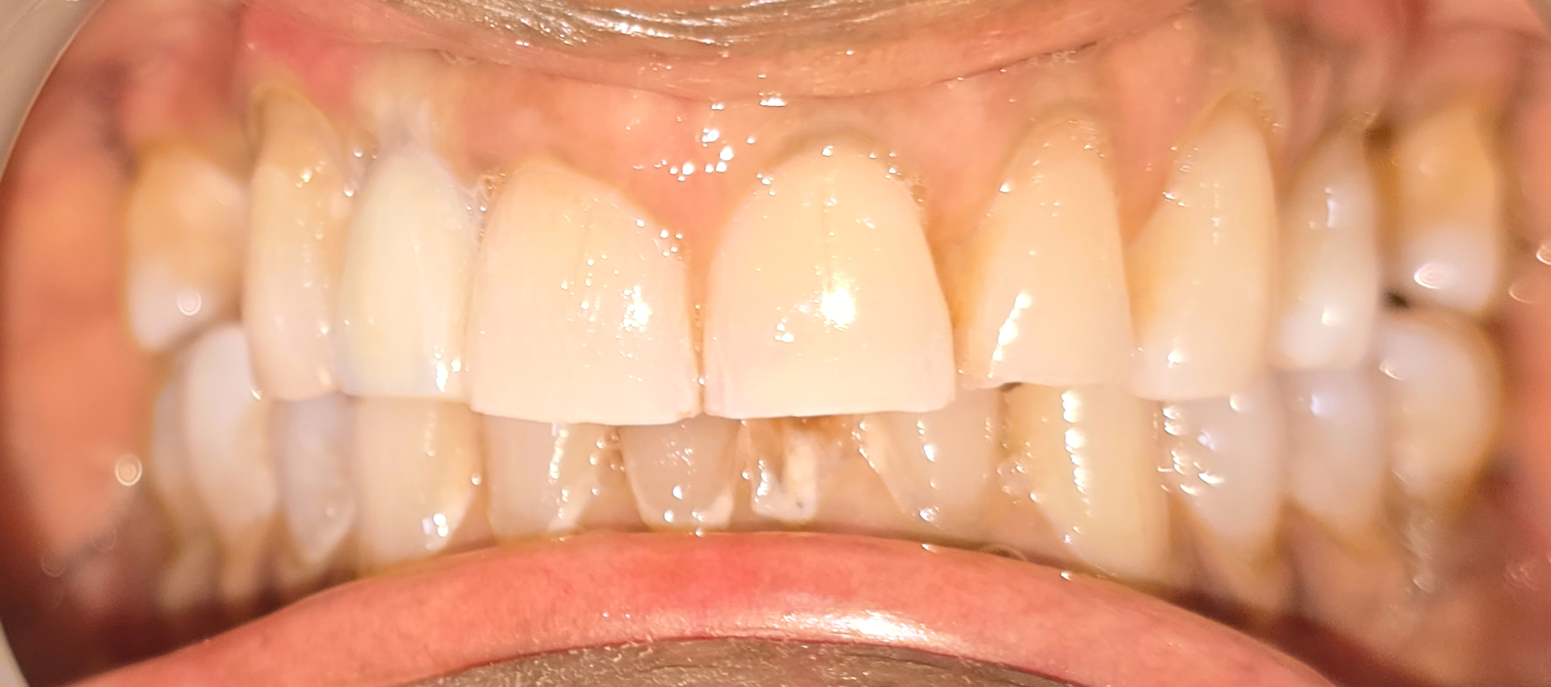 Post-treatment intraoral view showing the implant-supported ceramic crown matched to the adjacent central incisor and canine