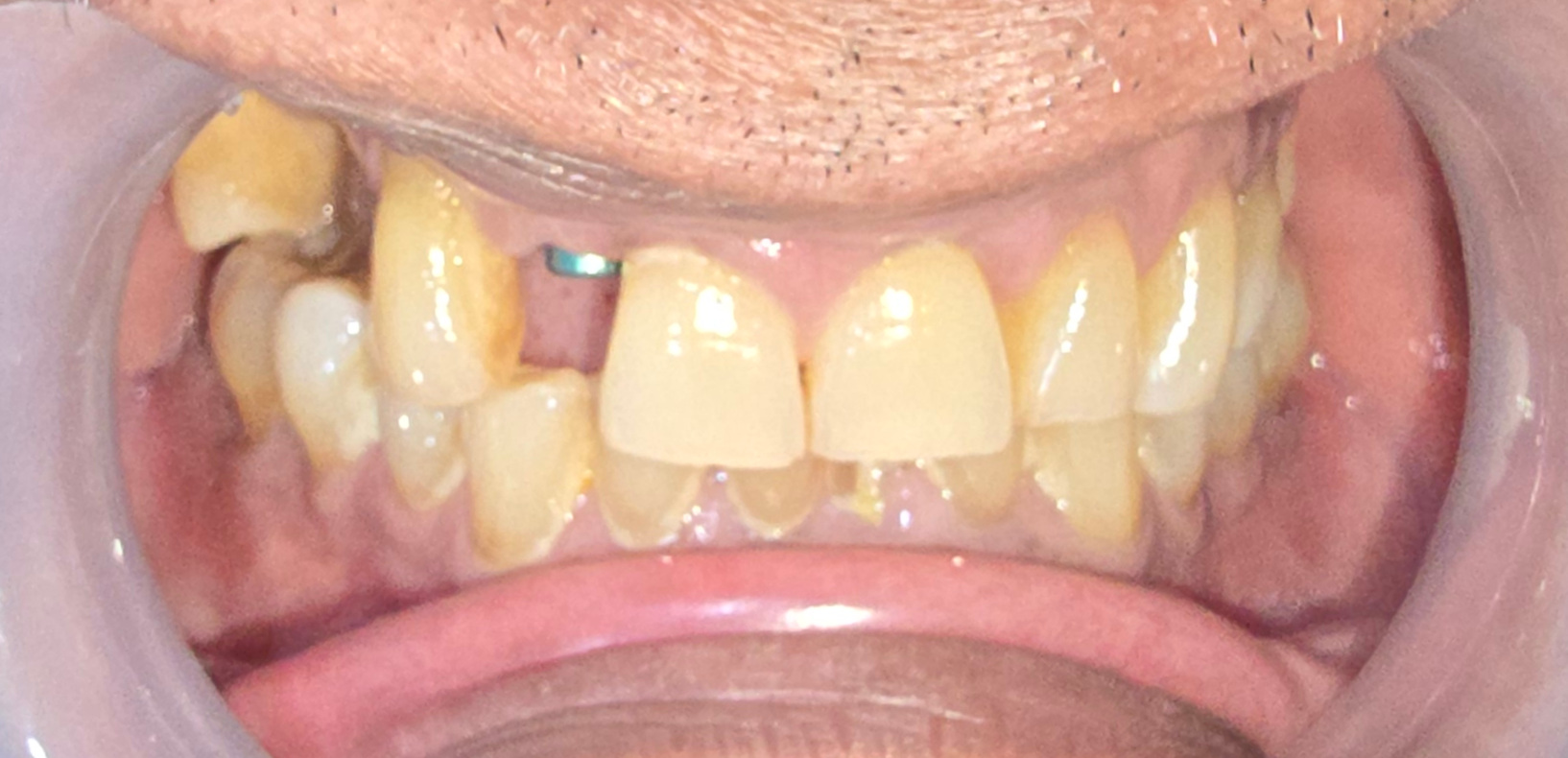 Pre-treatment intraoral view showing the edentulous space at the upper right lateral incisor
