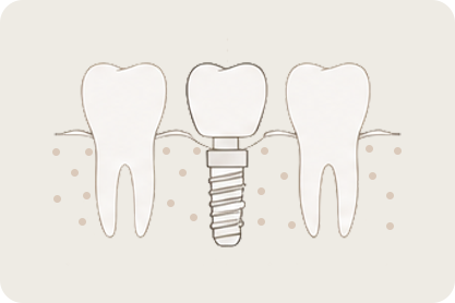 Dental implants and reconstruction at FaceLab